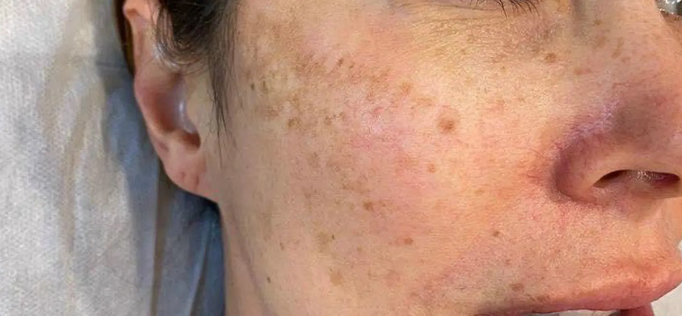 Hình ảnh so sánh làn da minh hoạ hiệu quả điều trị tại MiA Lyn Beauty & Clinic