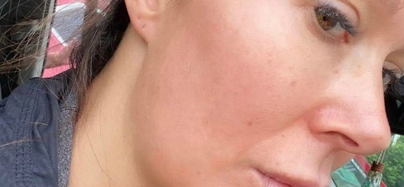 Hình ảnh làn da khách hàng tại MiA Lyn Beauty & Clinic