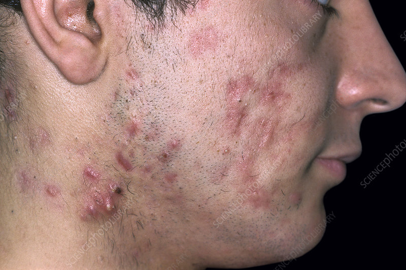 c0531913-nodulocystic-acne-on-the-face-1784105489.jpg