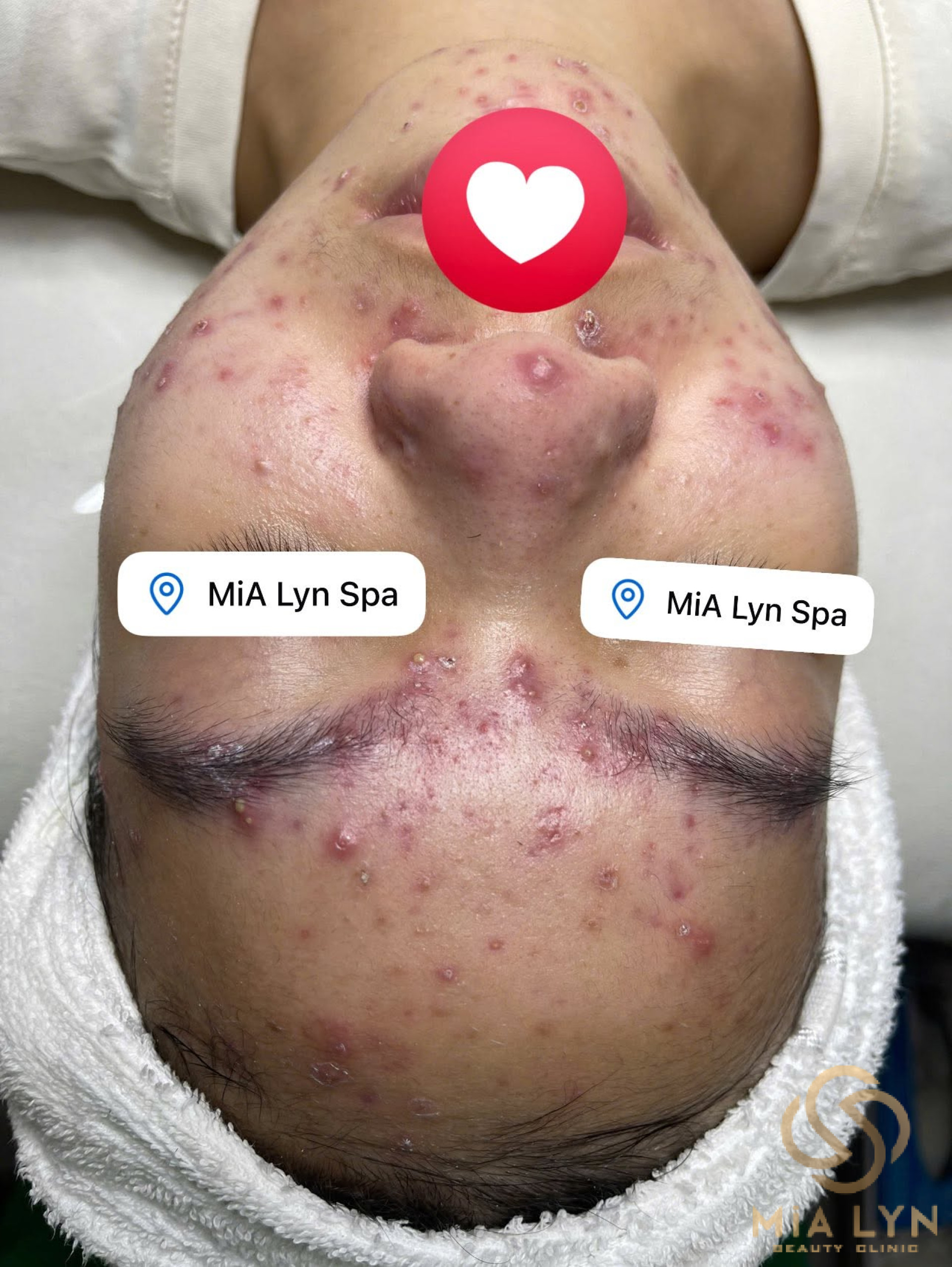 Mụn Viêm: Dấu Hiệu, Nguyên Nhân Và Cách Điều Trị Hiệu Quả