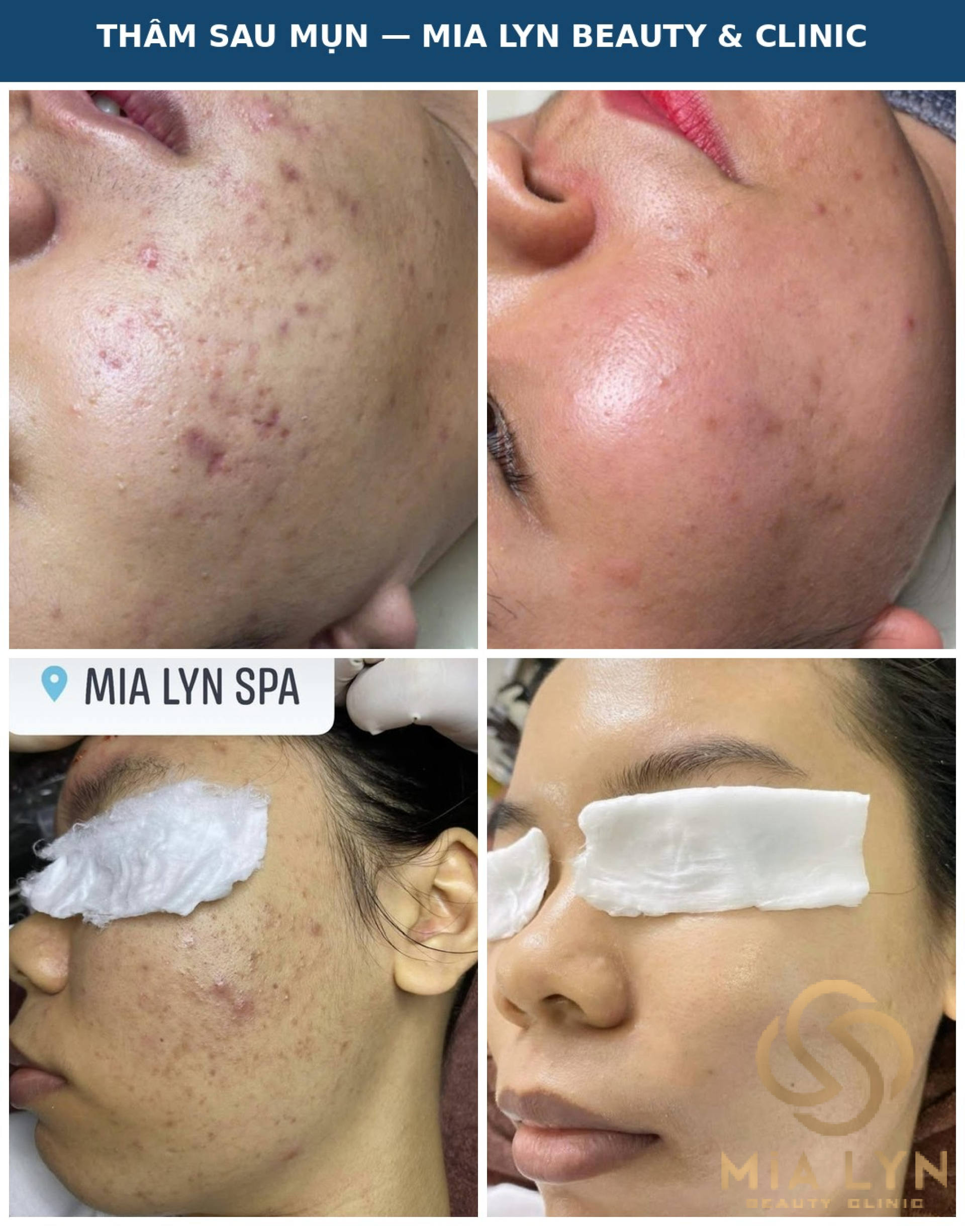 Thâm Sau Mụn Bao Lâu Thì Hết?