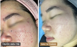 Ca lâm sàng: Sẹo rỗ dày đặc hai bên má ở nữ 28 tuổi - hành trình 14 tháng