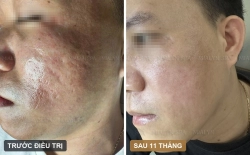 Ca lâm sàng: Sẹo rỗ kèm thâm sạm sau mụn ở nam 32 tuổi - hành trình 11 tháng