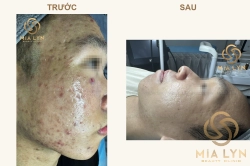 Ca lâm sàng sẹo rỗ lượn sóng, mụn ẩn kéo dài - 15 tháng