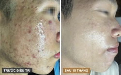 Ca lâm sàng: Sẹo rỗ lượn sóng và mụn ẩn kéo dài - 15 tháng phác đồ kết hợp