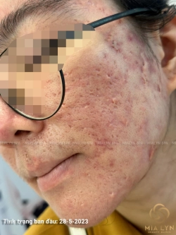 Các loại sẹo thường gặp: đặc điểm nhận biết và cách phân biệt