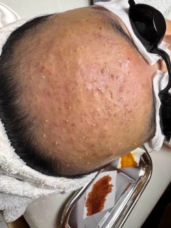 Có nên lấy nhân mụn không? Tìm hiểu khi nào nên lấy, khi nào không, và quy trình lấy nhân mụn an toàn giúp hạn chế thâm sẹo.