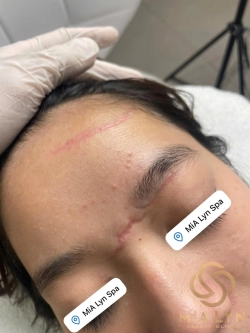 Da hình thành sẹo như thế nào? Giải mã quá trình lành thương