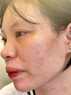 Da mụn có nên trang điểm không, cần lưu ý gì để tránh nặng hơn?