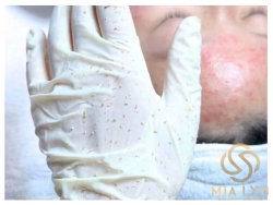 Dấu hiệu da đang bị bào mòn hàng rào bảo vệ da