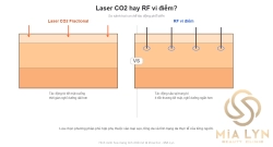 Laser CO2 hay RF vi điểm? So sánh 2 công nghệ trị sẹo rỗ