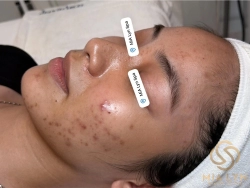 Tìm hiểu nguyên nhân gây mụn nội tiết ở nữ, cách nhận biết, điều trị và chăm sóc da.