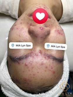 Mụn Viêm: Dấu Hiệu, Nguyên Nhân Và Cách Điều Trị Hiệu Quả
