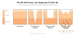 Phân biệt các loại sẹo rỗ: Icepick, Boxcar và Rolling qua hình dạng