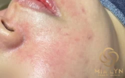 Phân biệt rosacea và mụn trứng cá: dấu hiệu nhận biết