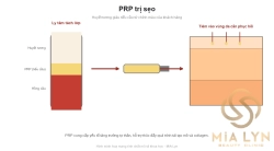 PRP trị sẹo: huyết tương giàu tiểu cầu hoạt động thế nào?
