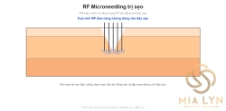 RF Microneedling trị sẹo: ứng dụng thực tế thế nào?