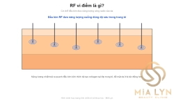 RF vi điểm là gì?