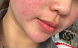 Rosacea là gì? Dấu hiệu, nguyên nhân và 4 thể thường gặp