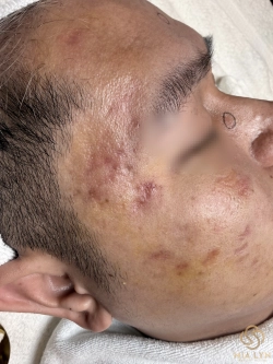 Sai lầm khi trị sẹo rỗ khiến kết quả không như mong đợi