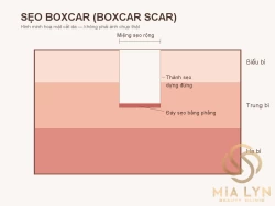 Sẹo rỗ đáy vuông (boxcar): đặc điểm và cách điều trị hiệu quả