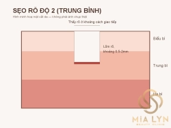 Sẹo rỗ độ 2: mức độ trung bình và hướng điều trị phù hợp