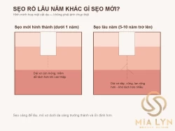 Sẹo rỗ lâu năm có còn trị được không?
