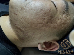 Sẹo rỗ sau mụn: Nguyên nhân và các phương pháp điều trị hiệu quả