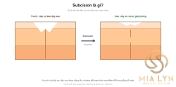 Subcision là gì? Kỹ thuật cắt dây xơ trị sẹo lượn sóng
