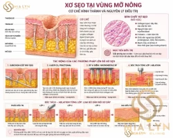 Xơ sẹo là gì? Vì sao trị sẹo rỗ cần xử lý xơ sẹo trước bề mặt da