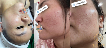 MỤN TRỨNG CÁ – VẤN ĐỀ DA LIỄU PHỔ BIẾN NHƯNG THƯỜNG BỊ HIỂU SAI