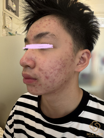 Mụn Tuổi Dậy Thì: Vì Sao Xuất Hiện Và Chăm Sóc Thế Nào?