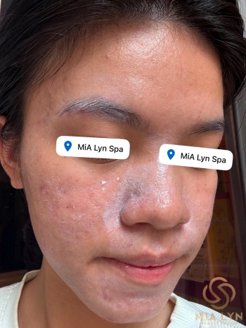 Phân biệt da nhạy cảm và da nhiễm corticoid