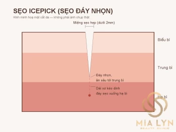 Sẹo rỗ đáy nhọn (icepick): vì sao khó trị nhất và cách xử lý