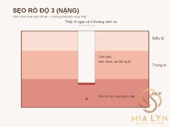 Sẹo rỗ độ 3: mức độ nặng và phác đồ điều trị cần thiết