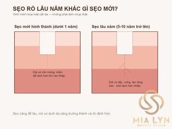 Sẹo rỗ lâu năm có còn trị được không?