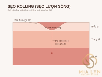Sẹo rỗ lượn sóng (rolling): cách nhận biết và điều trị