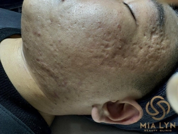 Sẹo rỗ sau mụn: Nguyên nhân và các phương pháp điều trị