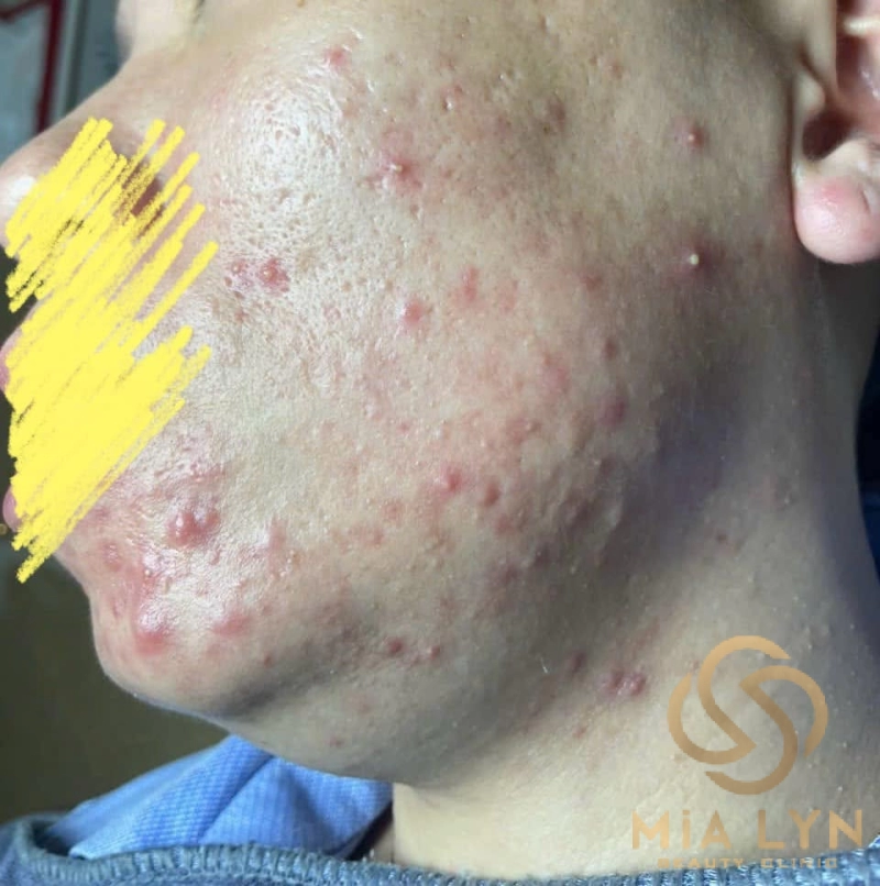 10 sai lầm khiến mụn mãi không khỏi
