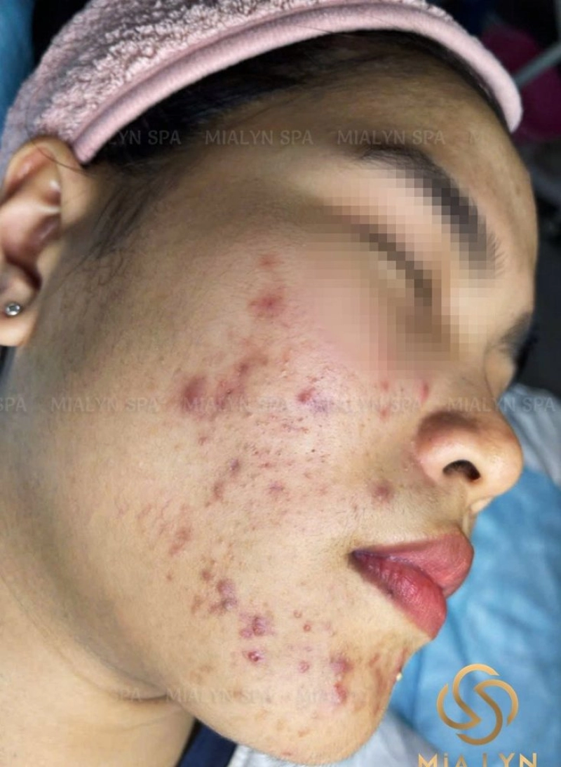 Mụn viêm, mụn mủ dày đặc vùng má và cằm trước điều trị