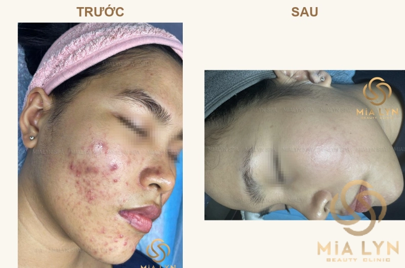 Ca lâm sàng: Hành trình 10 tháng trị mụn viêm nặng ở nữ 22 tuổi