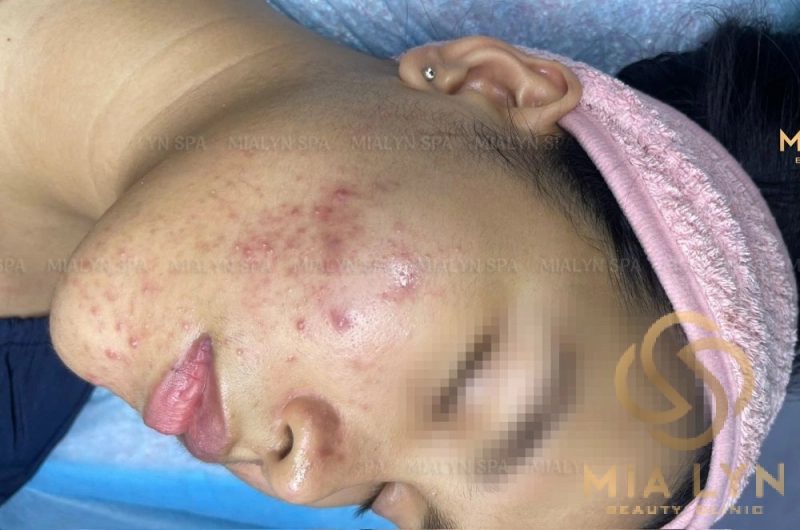 Mụn viêm lan rộng má trái khi bắt đầu điều trị