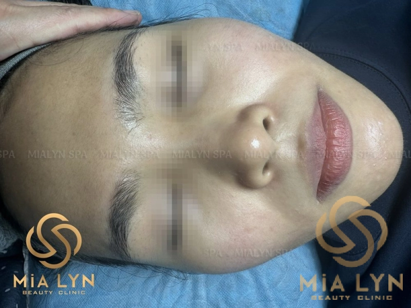 Sau 10 tháng: da sạch mụn, thâm mờ, không để lại sẹo rỗ rõ