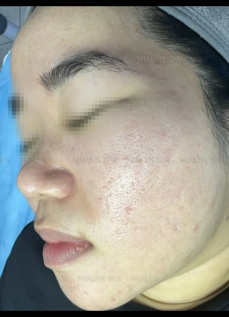 Sau 14 tháng: sẹo rỗ hai bên má nông đi rõ, da đều màu hơn
