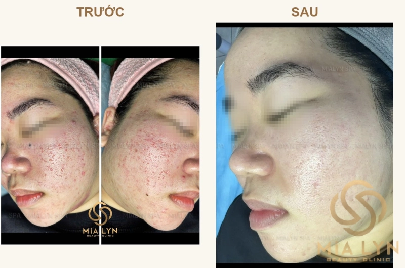 Ca lâm sàng: Sẹo rỗ dày đặc hai bên má ở nữ 28 tuổi - hành trình 14 tháng