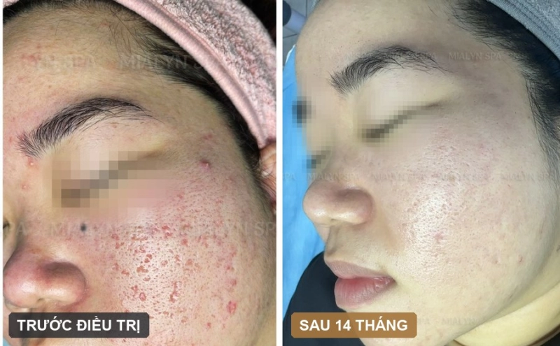 Ca lâm sàng: Sẹo rỗ dày đặc hai bên má ở nữ 28 tuổi - hành trình 14 tháng
