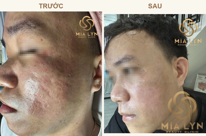 Ca lâm sàng: Sẹo rỗ kèm thâm sạm sau mụn ở nam 32 tuổi - hành trình 11 tháng