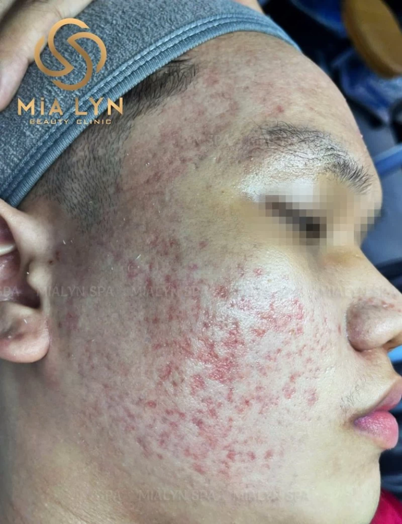 Hai bên má dày đặc thâm đỏ và sẹo rỗ li ti trước điều trị