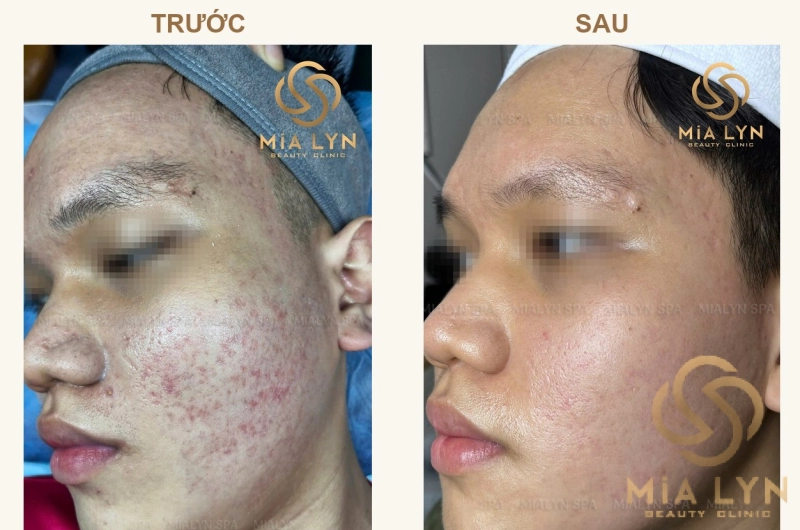 Ca lâm sàng: Sẹo rỗ li ti và thâm đỏ sau mụn ở nam 20 tuổi - hành trình 9 tháng