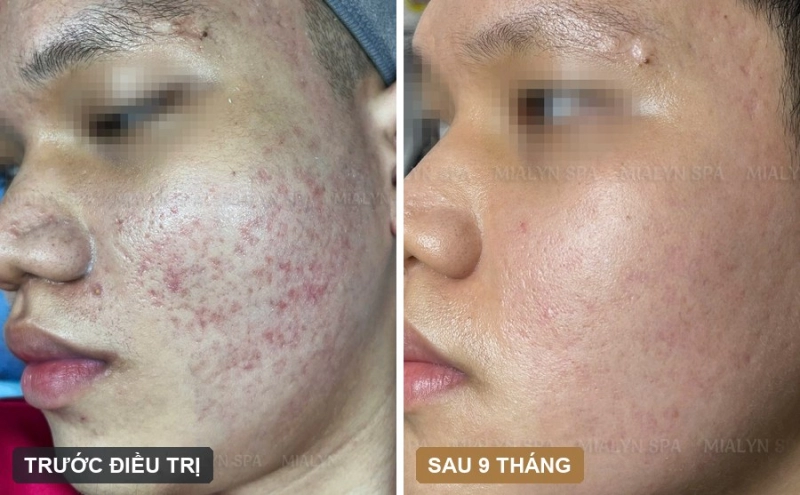 Ca lâm sàng: Sẹo rỗ li ti và thâm đỏ sau mụn ở nam 20 tuổi - hành trình 9 tháng